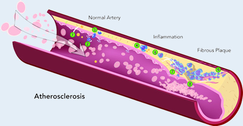 Heart Inflammation Illustration
